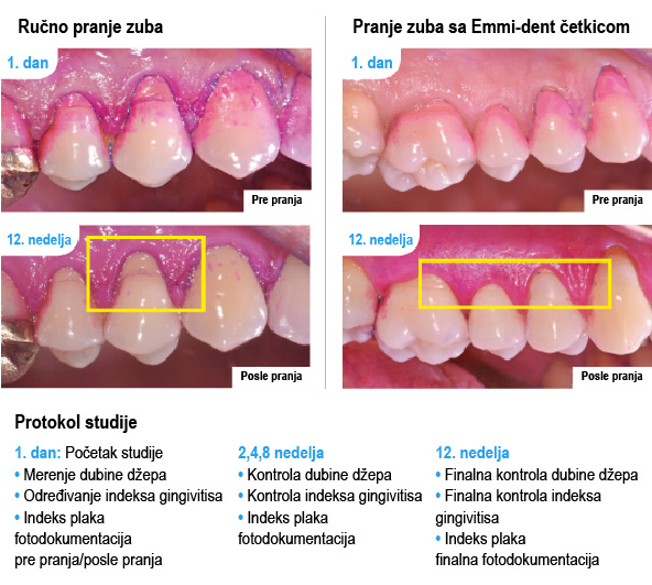 Emmi-dent - gingivitis, paradentoza - studija slučaja